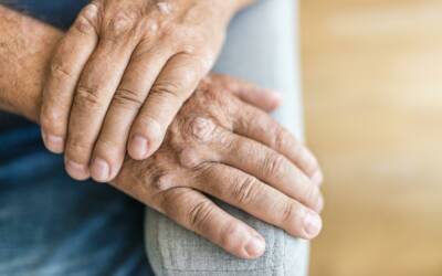 Come curare l’artrite psoriasica dell’anziano
